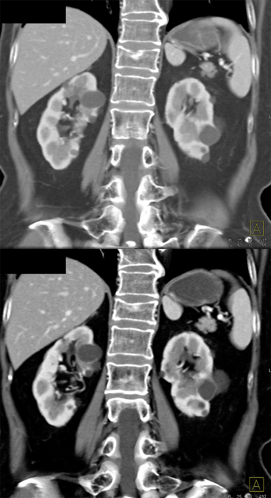 CT of Splenic Anomalies