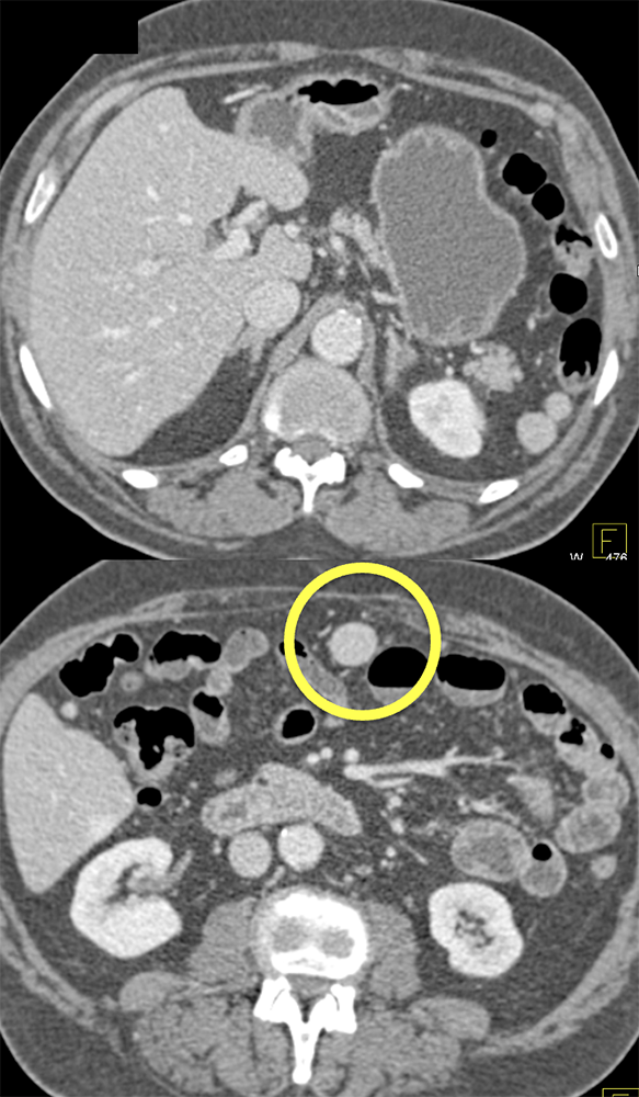 CT of Splenic Anomalies