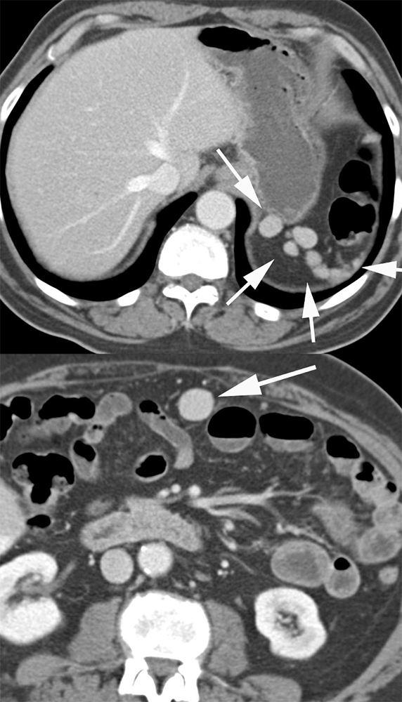 CT of Splenic Anomalies