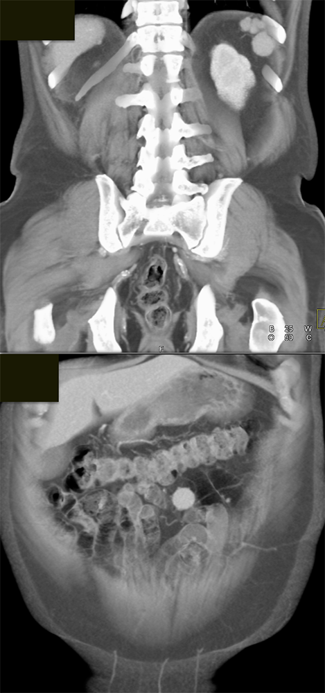 CT of Splenic Anomalies