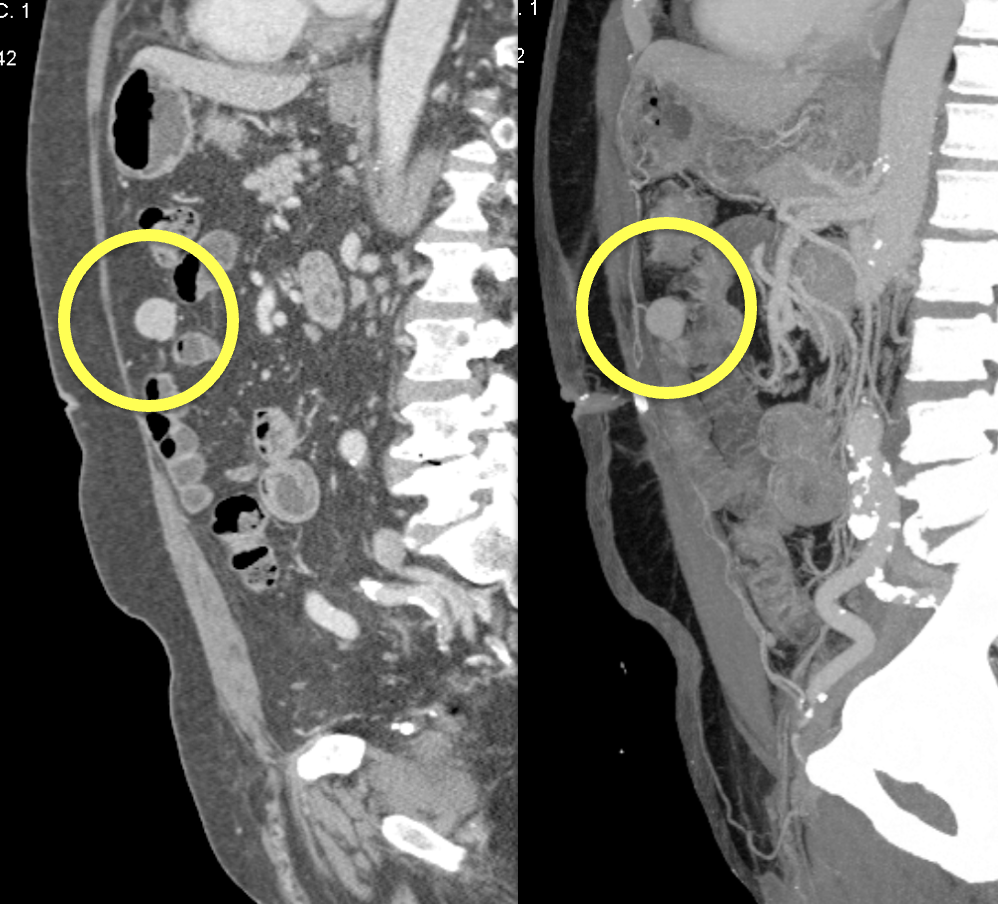 CT of Splenic Anomalies