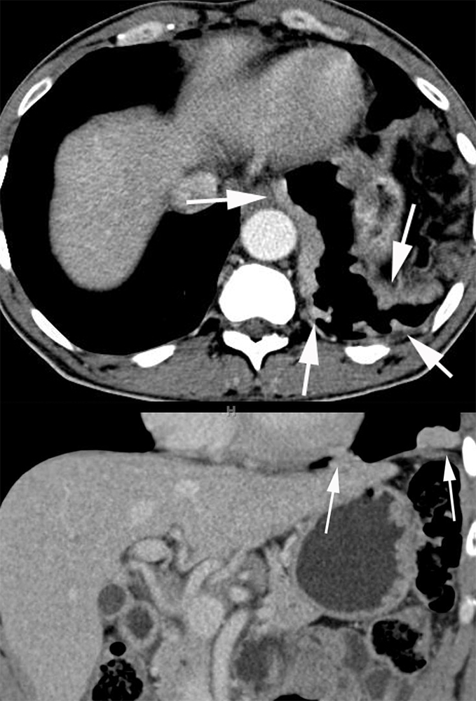 Splenosis with Pleural Implants