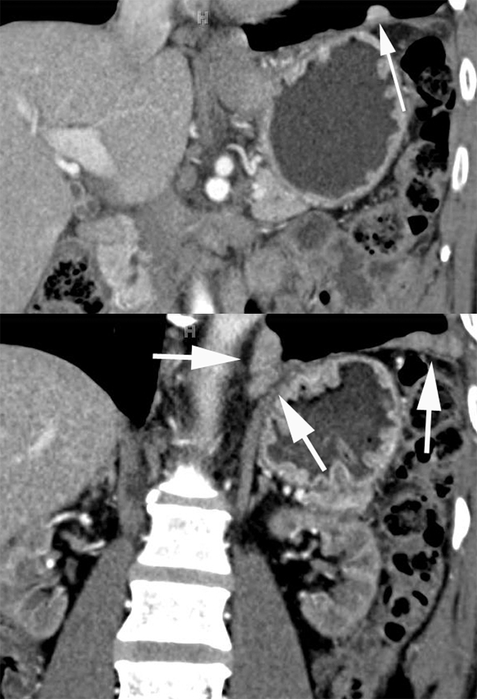 CT of Splenic Anomalies