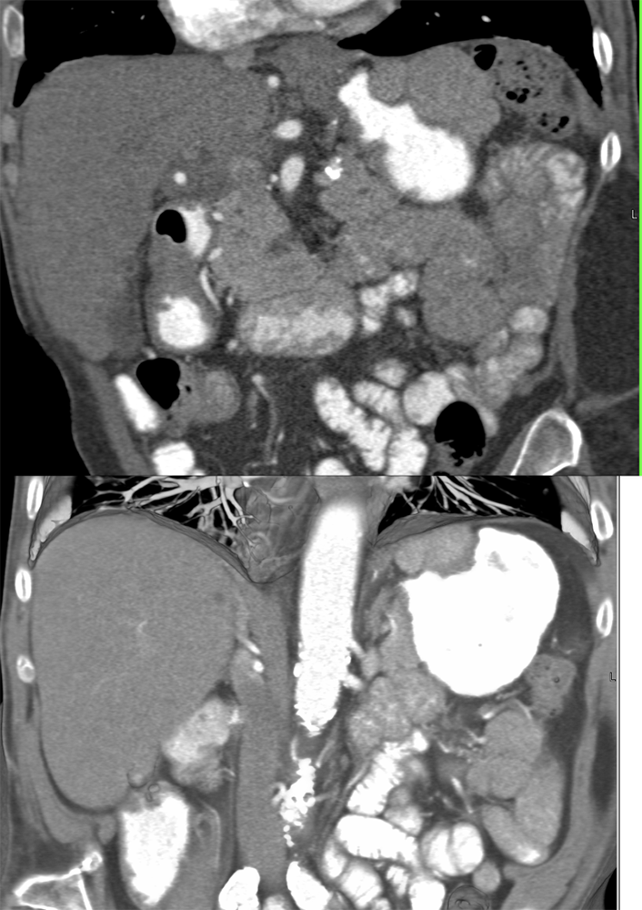 CT of Splenic Anomalies