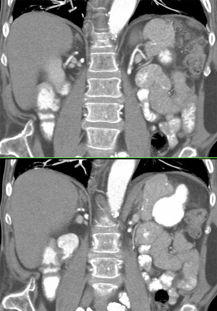 CT of Splenic Anomalies