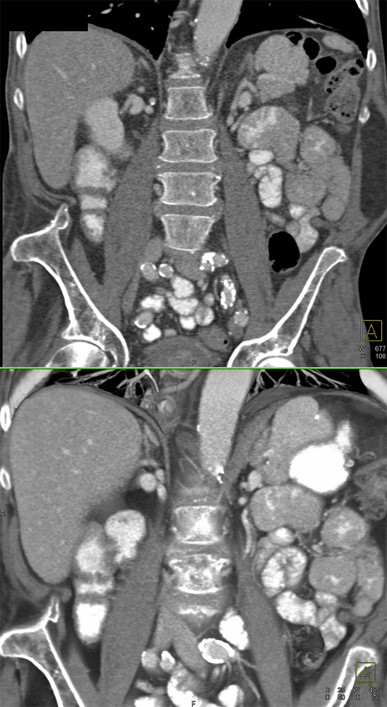 CT of Splenic Anomalies