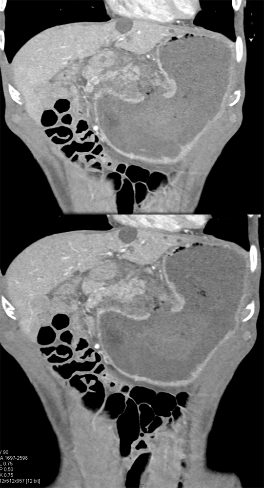 CT of the Stomach