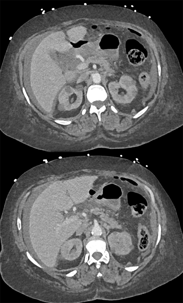 CT of the Stomach