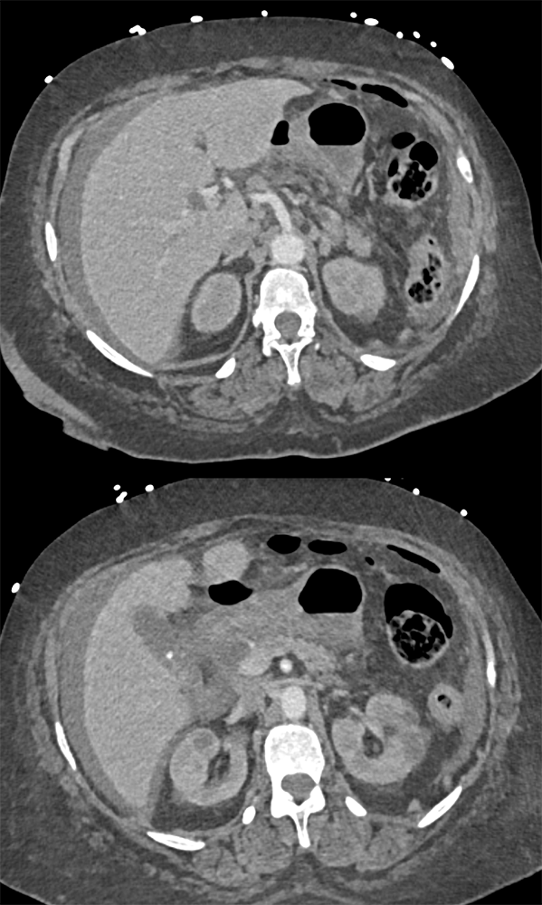 CT of the Stomach