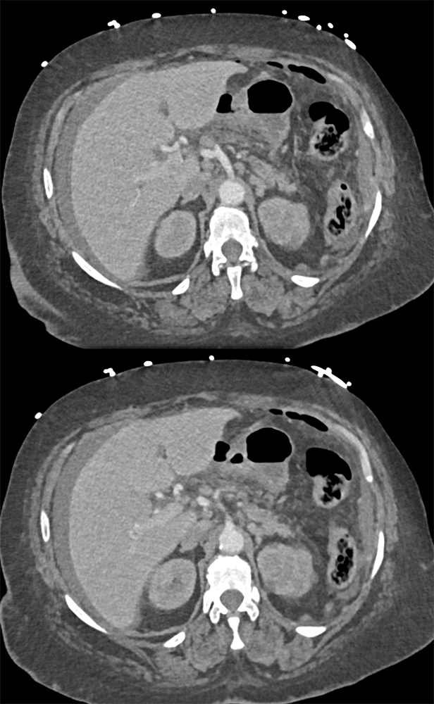 CT of the Stomach