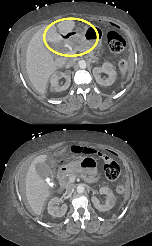 CT of the Stomach