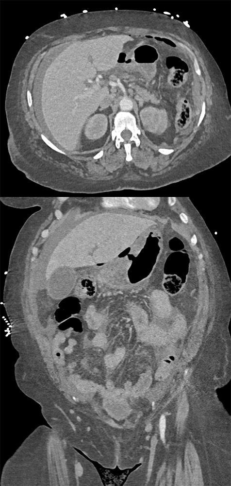 CT of the Stomach