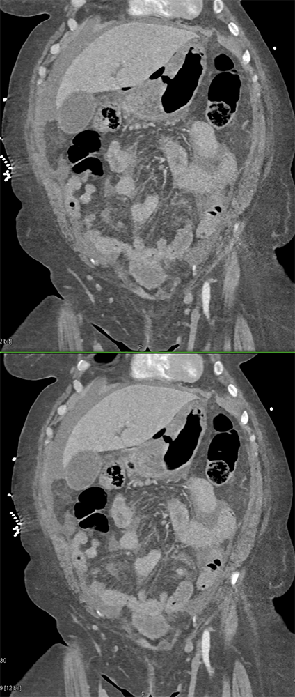 CT of the Stomach