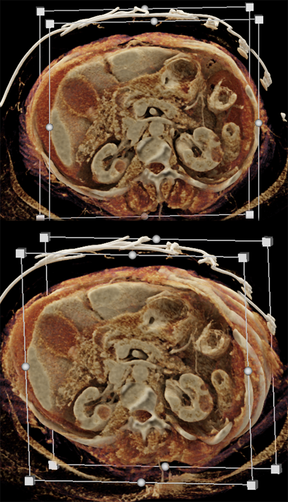 CT of the Stomach