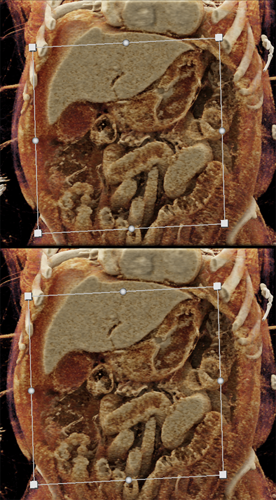 CT of the Stomach