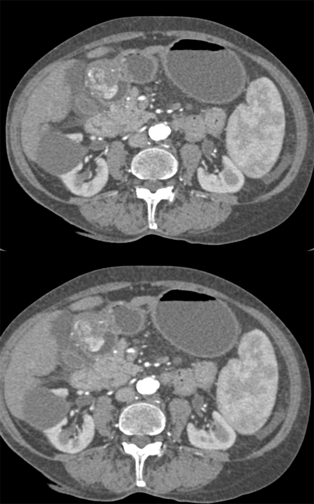 CT of the Stomach