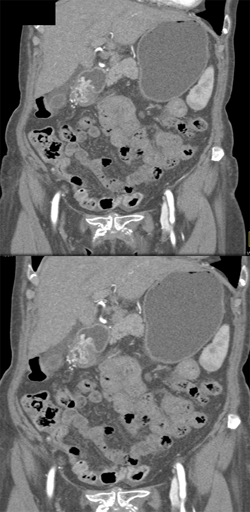 CT of the Stomach