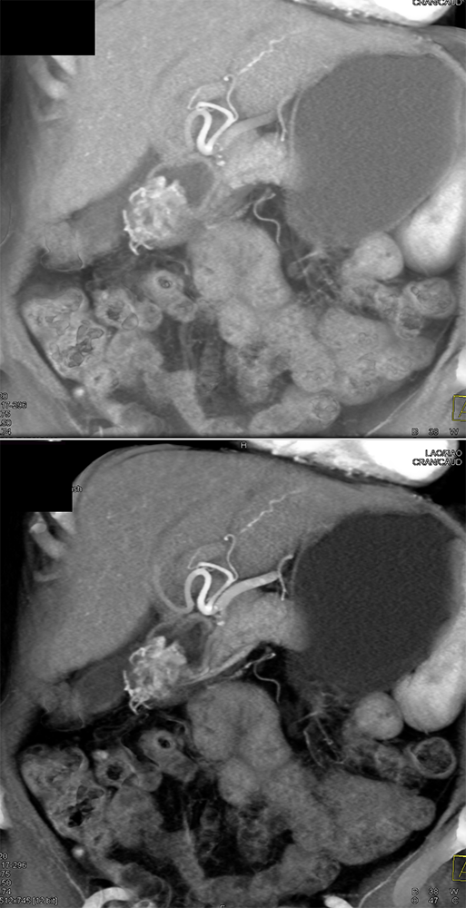 CT of the Stomach
