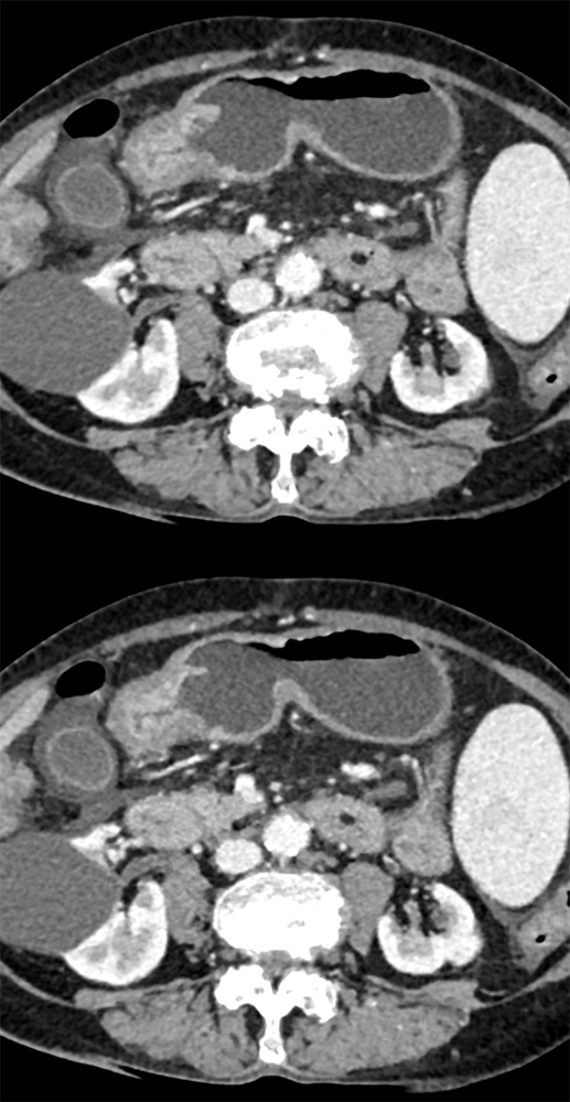 CT of the Stomach