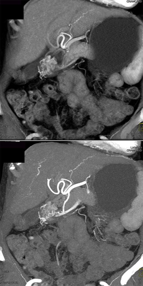 Watermelon stomach (WMS), or gastric antral vascular ectasia (GAVE)