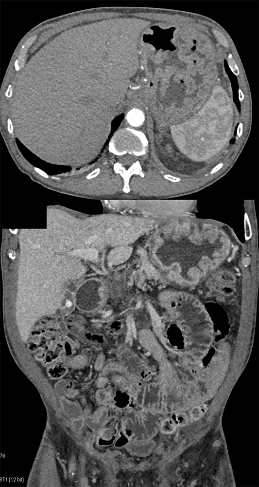 Chemical Gastritis from NSAIDs