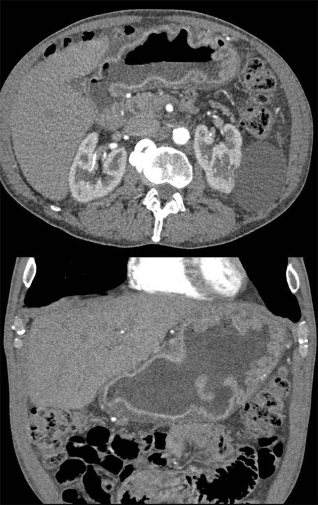 CT of the Stomach