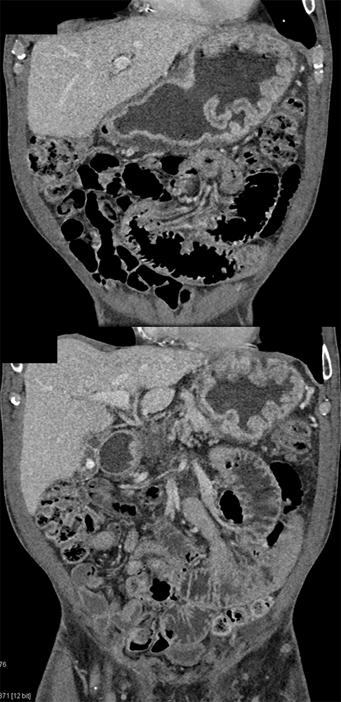 CT of the Stomach