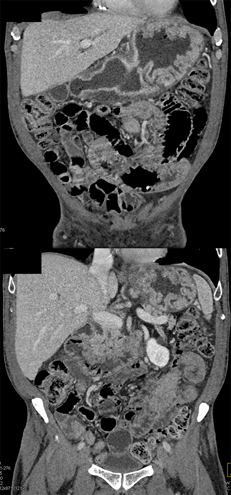 CT of the Stomach