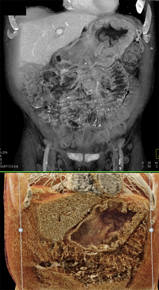 CT of the Stomach