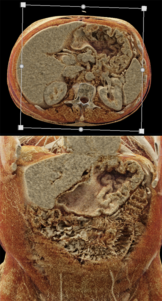 CT of the Stomach