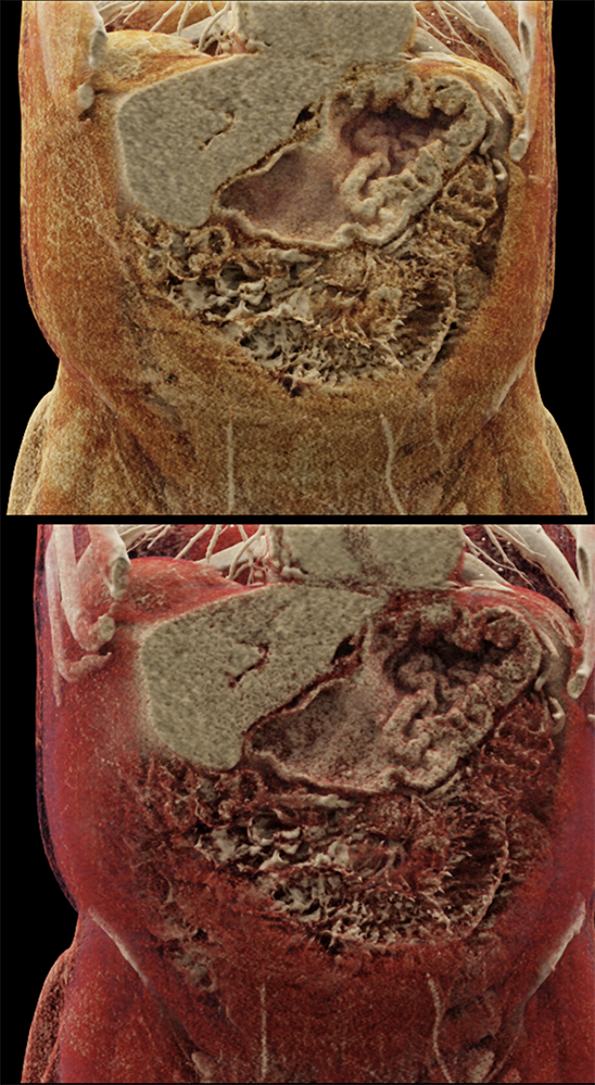 CT of the Stomach