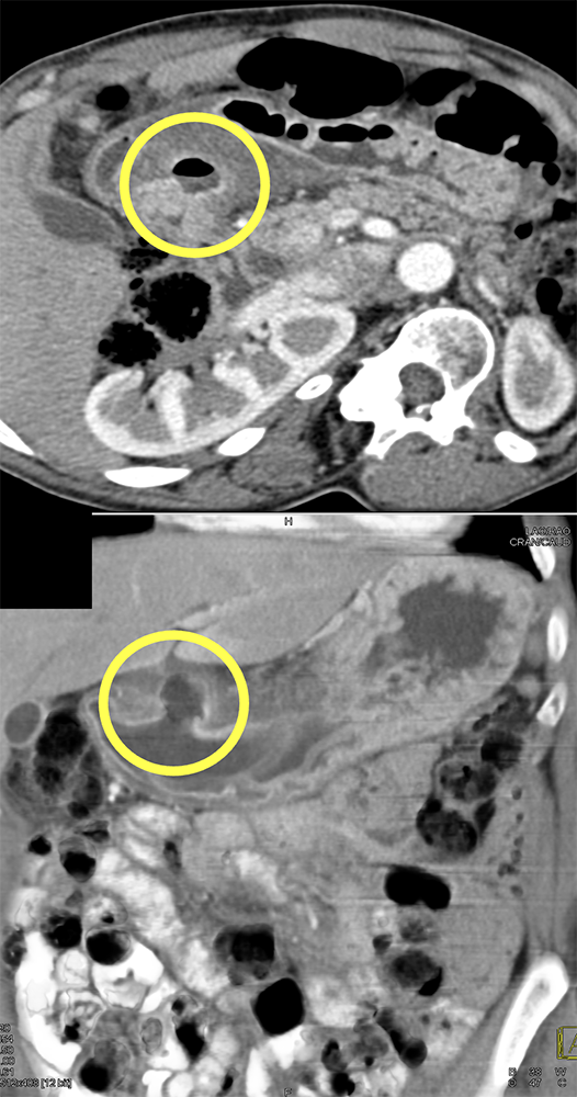 CT of the Stomach