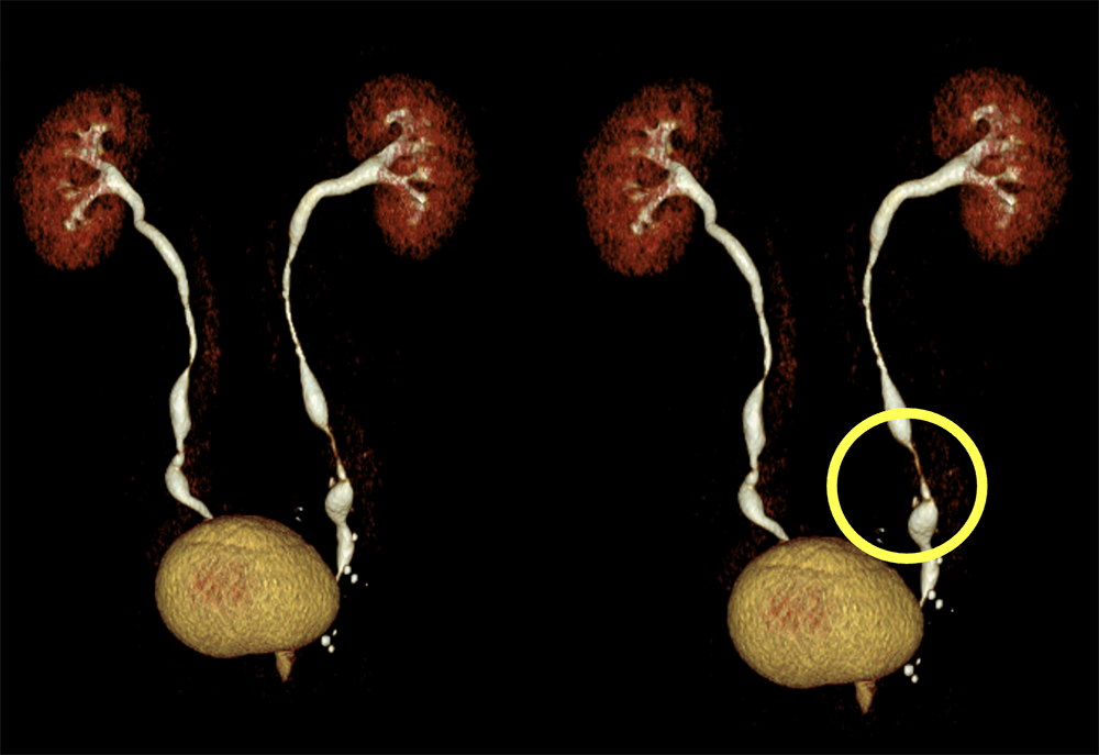 Transitional Cell Carcinoma of the Kidneys