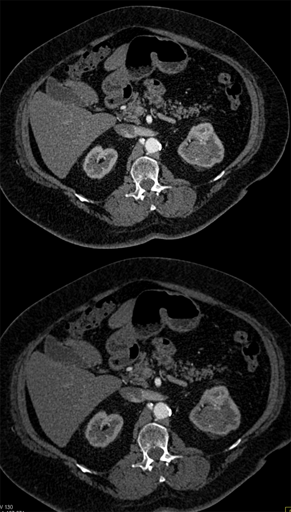 TCC Left Kidney