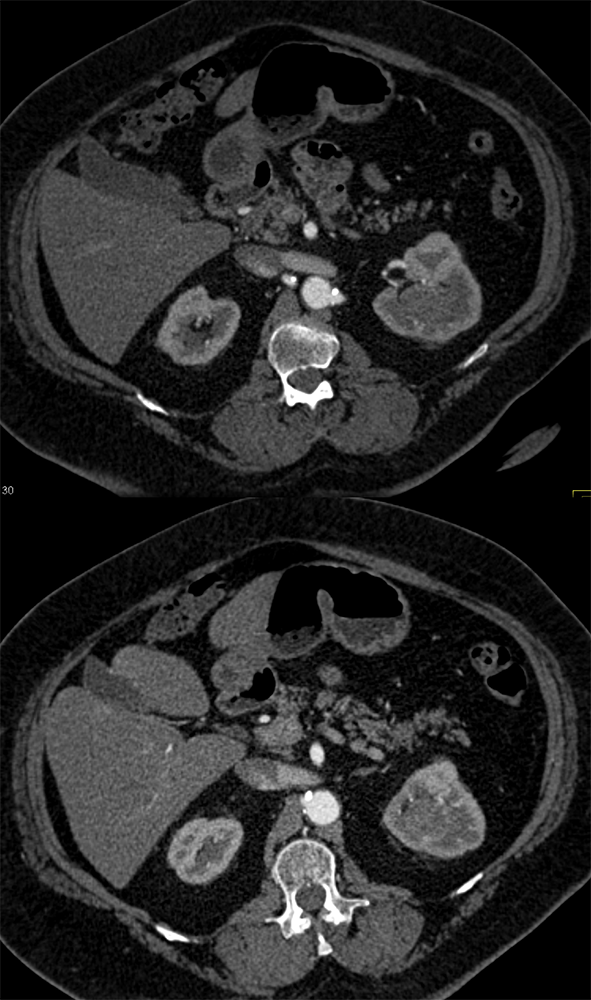 Transitional Cell Carcinoma of the Kidneys