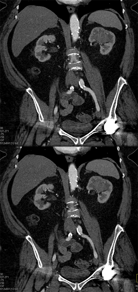 Transitional Cell Carcinoma of the Kidneys