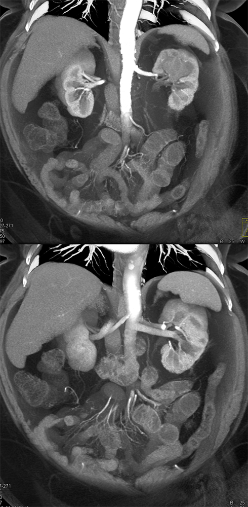 Transitional Cell Carcinoma of the Kidneys