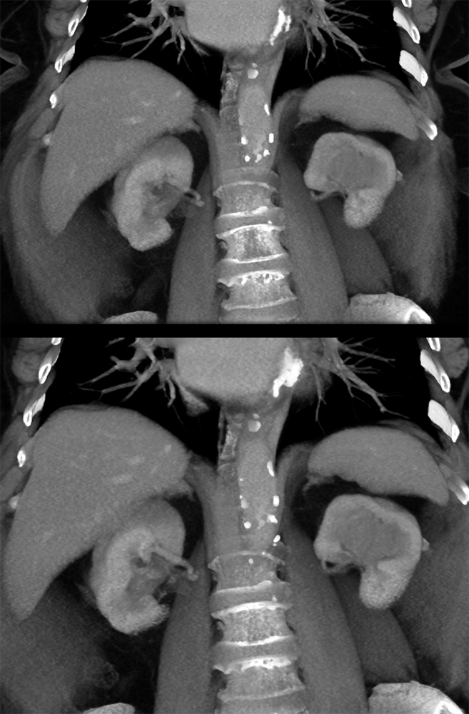 Transitional Cell Carcinoma of the Kidneys