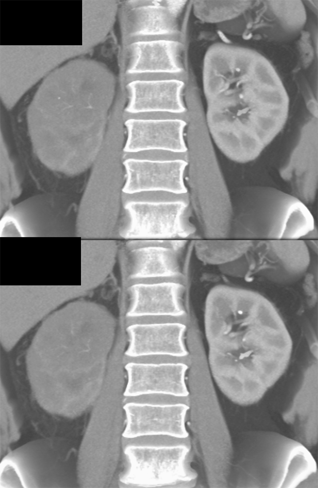 TCC Kidney