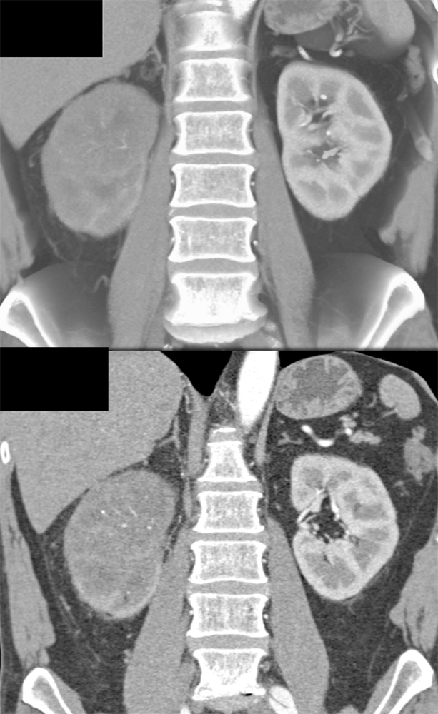 Transitional Cell Carcinoma of the Kidneys