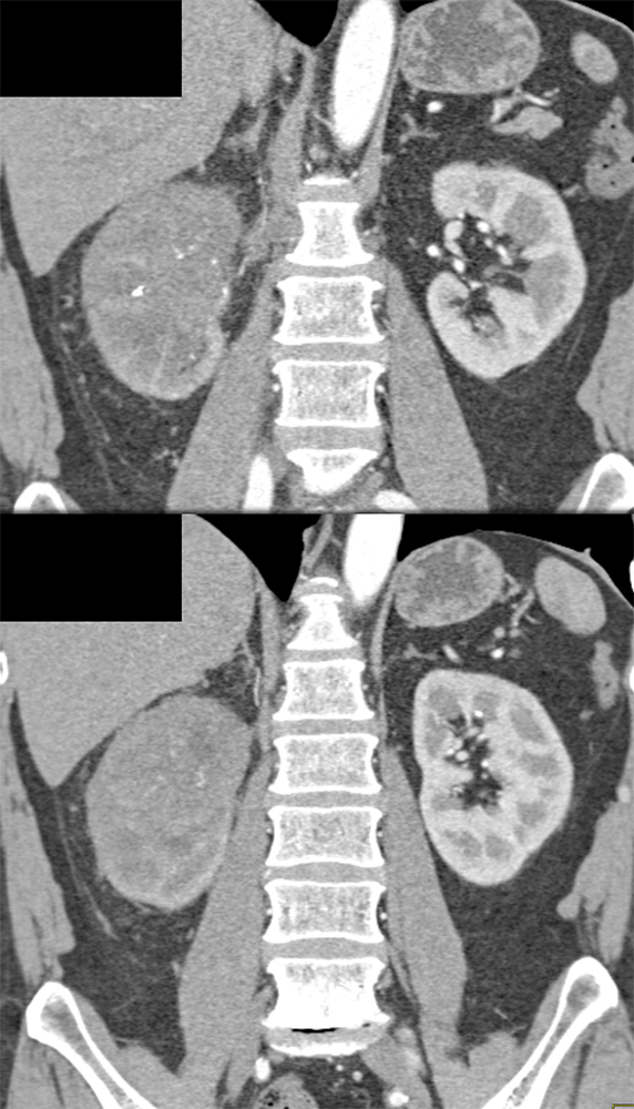 Transitional Cell Carcinoma of the Kidneys