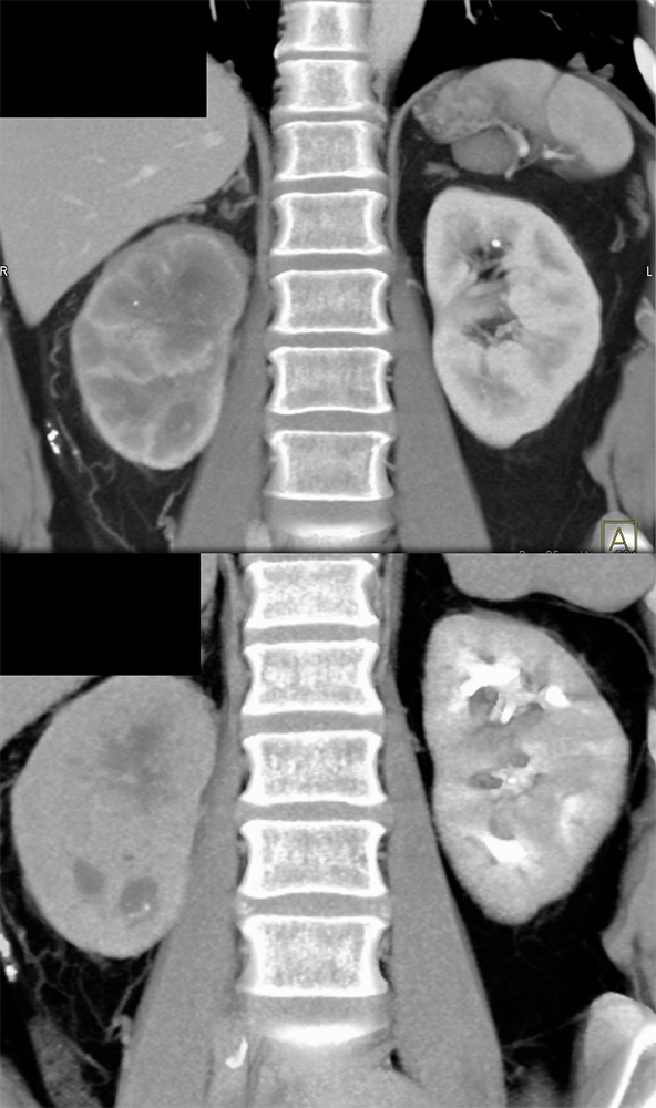 Transitional Cell Carcinoma of the Kidneys