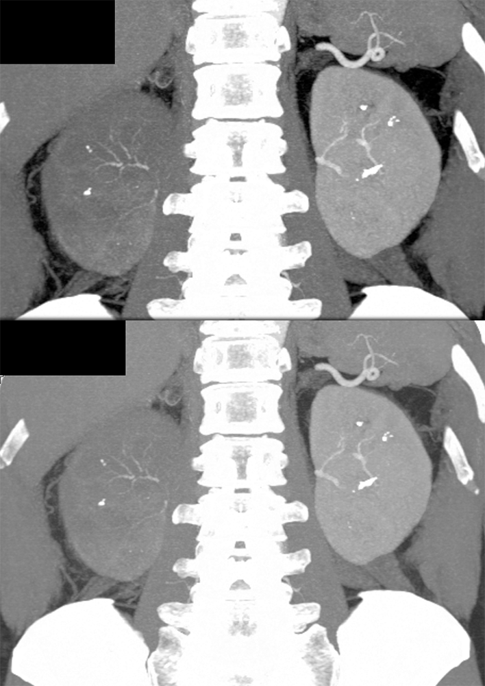 Transitional Cell Carcinoma of the Kidneys