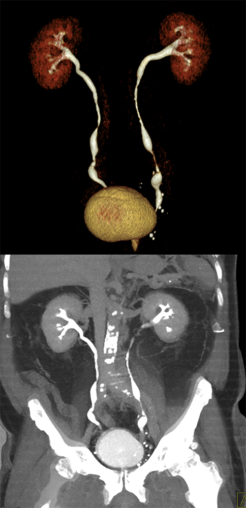 Transitional Cell Carcinoma of the Kidneys