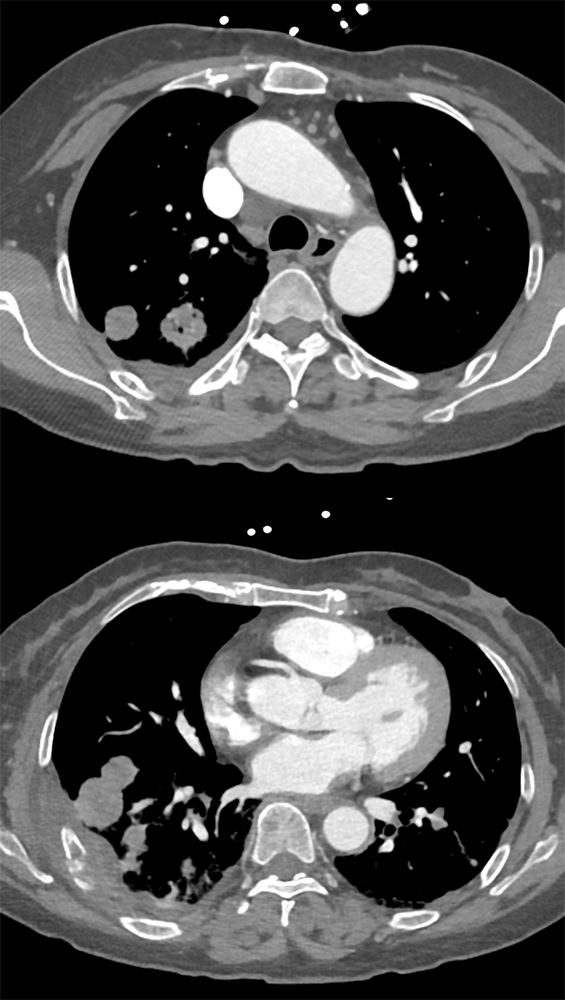 TCC Left Kidney