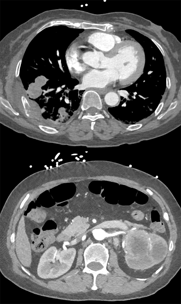 Transitional Cell Carcinoma of the Kidneys