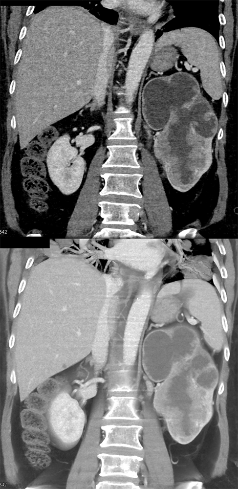 Transitional Cell Carcinoma of the Kidneys