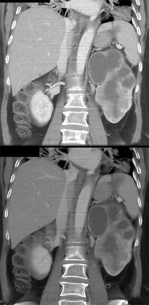 Transitional Cell Carcinoma of the Kidneys