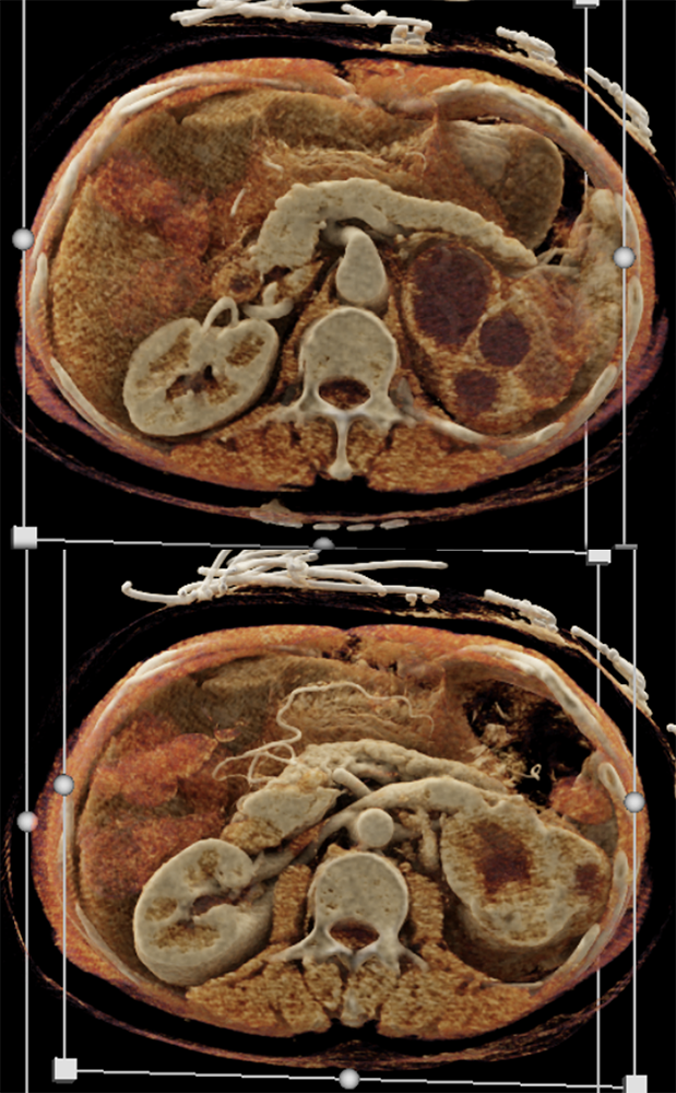 Transitional Cell Carcinoma of the Kidneys