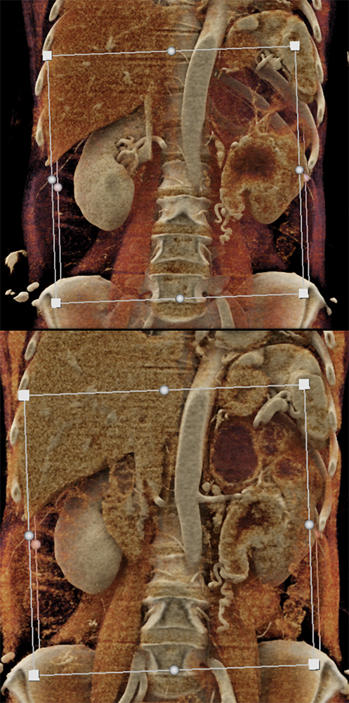 Transitional Cell Carcinoma of the Kidneys